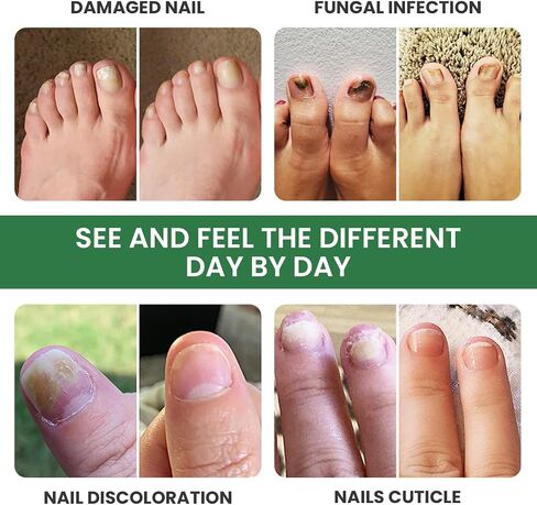Toenail Renewal Solution Extra Strength Care for Toe Nail & Fingernails - Nail Repair Solution for Thick, broken, Discolored Nails - Renews Damaged Cracked Ingrown Toenail - Tea Tree Oil for Healthier and Extra Strength Nails - Made In USA 0.50 Fl Oz - 1  in Kuwait