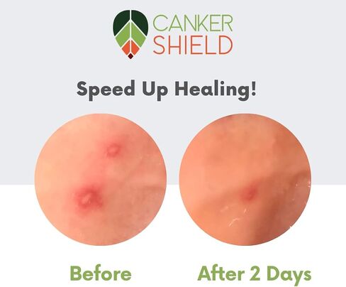 Canker Shield - Natural Rapid Healing Canker Sore Treatment and Mouth Ulcer Treatment - Works to Quickly Relieve Pain, Heal, and Prevent Canker Sores and Mouth Ulcers. in Saudi Arabia