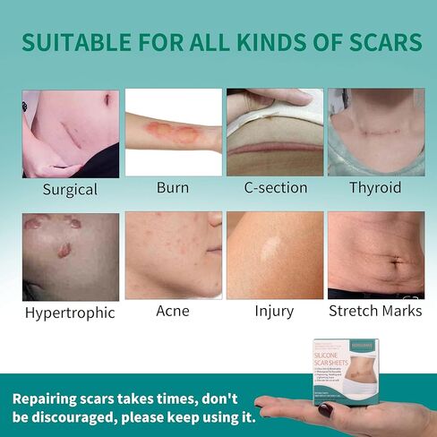 شريط ندبة من السيليكون من Norsumkn مقاس 1.6 × 60 بوصة، ورقة سيليكون قابلة لإعادة الاستخدام لعلاج الندبات وإزالة علامات التمدد وإزالة الوشم وإزالة الندبات غير المؤلمة للجراحة، القسم C، حب الشباب، الجدرة in Kuwait