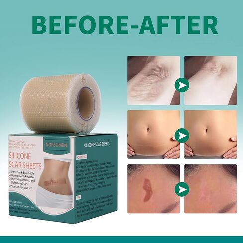 شريط ندبة من السيليكون من Norsumkn مقاس 1.6 × 60 بوصة، ورقة سيليكون قابلة لإعادة الاستخدام لعلاج الندبات وإزالة علامات التمدد وإزالة الوشم وإزالة الندبات غير المؤلمة للجراحة، القسم C، حب الشباب، الجدرة in Kuwait