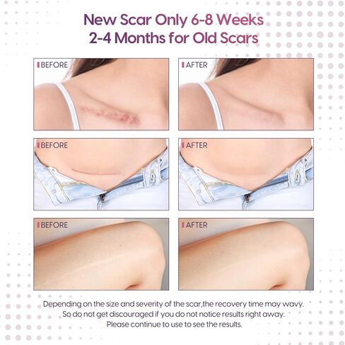 Silicone Scar Sheets (1.6" x 150" Roll-3.8M), Morfone Silicone Scar Tape, Professional and Effective Silicone Scar Removal Strips for C-Section, Surgery, Burn, Keloid, Acne, Upgrade Waterproof in Kuwait