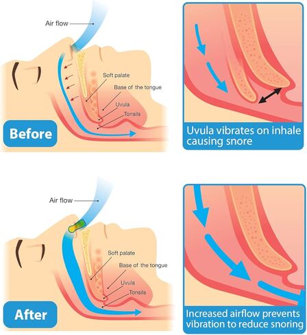 أجهزة مكافحة الشخير - مشبك أنف مغناطيسي من السيليكون مضاد للشخير، حل للشخير - أنف مريح لتخفيف الشخير (4 قطع) in Kuwait