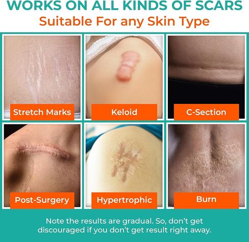 Medical Grade Silicone Scar Sheets – Silicone Gel Sheets for Scars - Self Adhesive, Thin, Breathable Silicone Scar Tape for Stretch Marks, Hypertrophic & Keloid Scar Removal, Pack of 5 (5.91" x 1.57") in Saudi Arabia