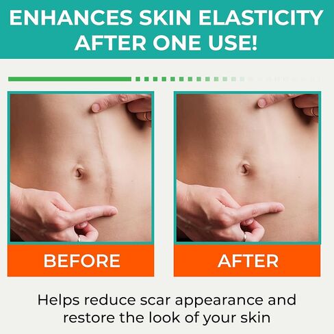 Medical Grade Silicone Scar Sheets – Silicone Gel Sheets for Scars - Self Adhesive, Thin, Breathable Silicone Scar Tape for Stretch Marks, Hypertrophic & Keloid Scar Removal, Pack of 5 (5.91" x 1.57") in Saudi Arabia