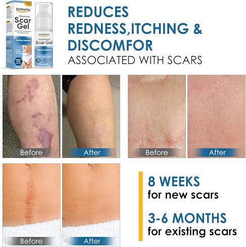 جل كريم الندبات، علاج متقدم للندبات للوجه والجسم، علاجات إزالة الندبات للندبات الجراحية، القسم C، علامات التمدد، حب الشباب، الجدرة، الحروق، الندبات القديمة والجديدة in Kuwait