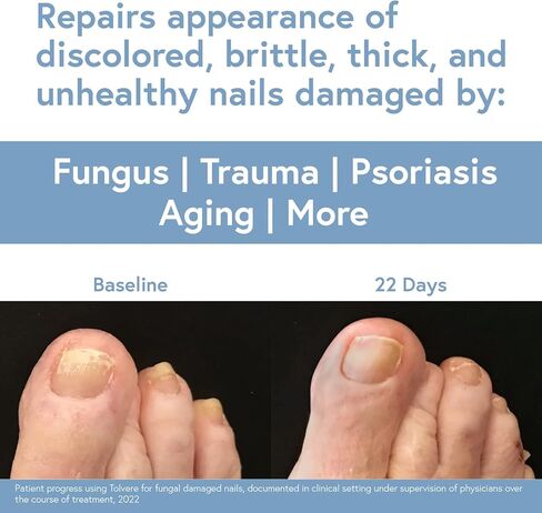 Tolvere Nail Renewal Solution, From the Makers of Tolcylen, Rapidly Improve Appearance of Discolored, Brittle, and Cracked Nails in Saudi Arabia