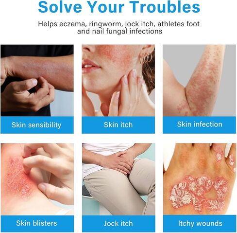 iTecFreely Jock Itch Cream, Powerful & Fast Jock Itch Cream, Jock Itch Treatment Extra Strength for Men & Women, Tinea Corporis, Itch Cream- 60g in Kuwait