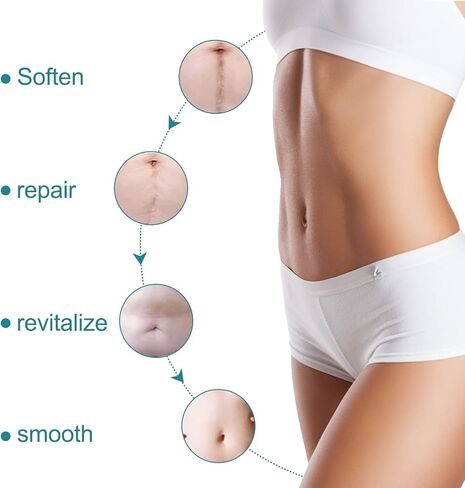 KUREWO Silicone Scar Tape Scar Sheet - Upgrade Professional Medical Scar Removal Treatment, Non irritating, Reusable, Painless for C-Section, Surgical Scars, Burn, Keloid, Acne et in Saudi Arabia