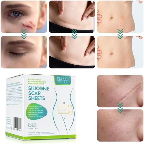 KUREWO Silicone Scar Tape Scar Sheet - Upgrade Professional Medical Scar Removal Treatment, Non irritating, Reusable, Painless for C-Section, Surgical Scars, Burn, Keloid, Acne et in Saudi Arabia