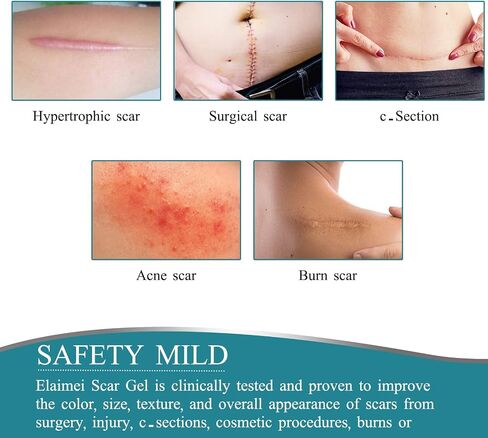 KUREWO Silicone Scar Tape Scar Sheet - Upgrade Professional Medical Scar Removal Treatment, Non irritating, Reusable, Painless for C-Section, Surgical Scars, Burn, Keloid, Acne et in Saudi Arabia