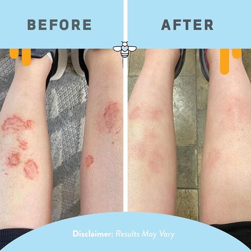 PSORIASIS HONEY Skin-Renewing Cream - Psoriasis Cream for Dry Skin - Daily Ointment & Moisturizer for Eczema Or Sensitive Skin - Psoriasis Lotion for Itchy Skin Relief (4oz) in Saudi Arabia