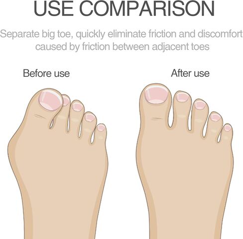 4 Pcs Toe Splint, Toe Straightener for Hammer Toe, Toe Corrector for Women Men, Bent Toe, Claw Toe, Crooked Toe, Curled Toe, Toe Wrap to Align and Support Toe (Blue) in Saudi Arabia
