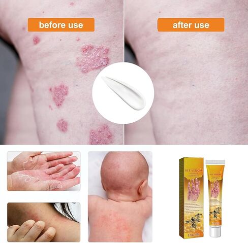 3 قطع من كريم العناية بالصدفية بسم النحل من AQISI، كريم العناية بالصدفية الاحترافي لسم النحل النيوزيلندي، كريم الصدفية المهدئ والمرطب in Kuwait