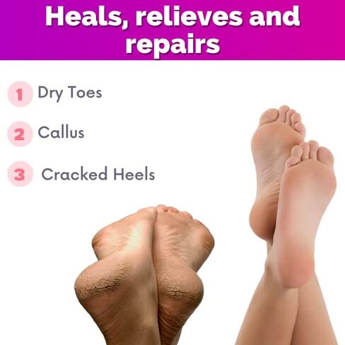 Foot Cream, Cracked Heel Repair, Foot Cream for dry cracked heels and feet, Dry feet, Foot care cream with Urea and Lactic acid. cracked heel tcream, Improve the appearance of your heels in Saudi Arabia