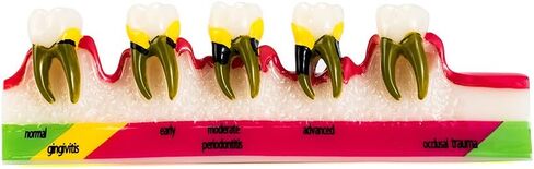 Easyinsmile أمراض اللثة متنوعة نموذج الأسنان Typodont دراسة نموذج لشكل الأسنان in Kuwait