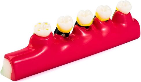 Easyinsmile أمراض اللثة متنوعة نموذج الأسنان Typodont دراسة نموذج لشكل الأسنان in Kuwait