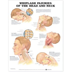 Whiplash Injuries of the Head and Neck Anatomical Chart in Saudi Arabia