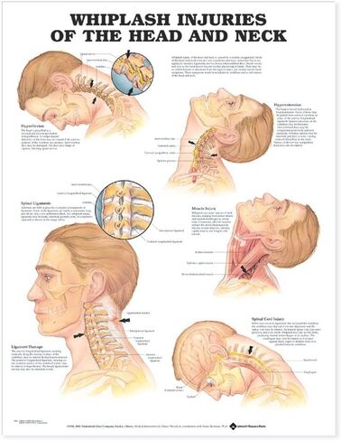 Whiplash Injuries of the Head and Neck Anatomical Chart in Saudi Arabia