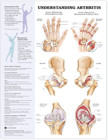 Understanding Arthritis Anatomical Chart in Saudi Arabia