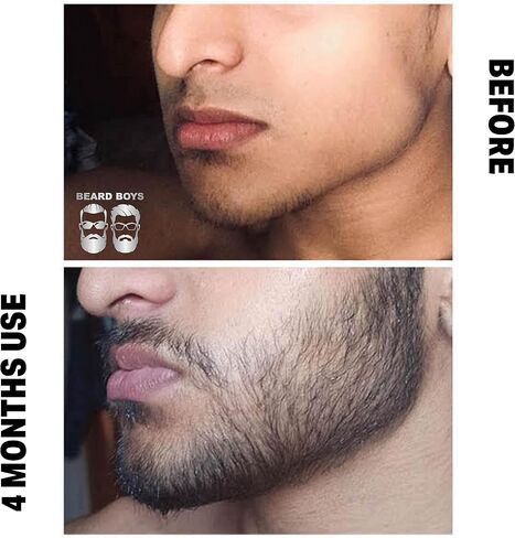 Beard Boys Beard Growth Kit - Beard Growth Oil - Beard Growth Roller - Beard Growth Vitamins - Beard Roller 0.25mm - Best Beard Growth Kit - Thicker Beard - (BB BGK) in Saudi Arabia