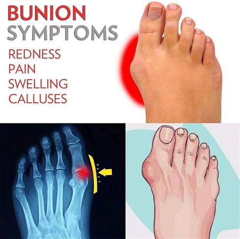 Yytcsjz Mens Slide Sandals Open Toe, Big Toe Bone Corrector Sandals, Athletic Adjustable Straps Orthotic, for Bunion Splints Toe Separator Beach Travel (Color : Black, Size : 8.5) in Saudi Arabia