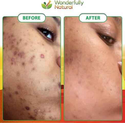 Organic African Black Soap - For Acne & Dark Spots | Natural Vegan and Cruelty Free – Satisfaction Guarantee 1lb bar | 90 day Supply in Saudi Arabia
