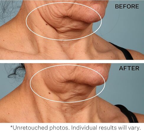StriVectin Tighten & Lift Advanced Neck Cream PLUS with Alpha-3 Peptides™ for Neck & Décolleté, Smoothing Look of Wrinkles & Fine Lines, Improves Crepey Skin & Vertical Lines, for Soft Smooth Skin in Kuwait