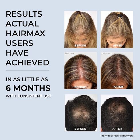 Hairmax Ultima 9 (FDA Cleared) Laser Hair Growth Comb, 100% Medical Grade Lasers (No LEDs), Laser Hair Growth Treatment for Men & Women, Thinning Hair Treatment for Women and Men, Denser & Fuller Hair, Spot or Full Scalp Coverage, Hair Growth Products to  in Saudi Arabia