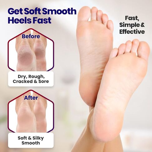 Moisturizing Socks for Mens Cracked Heels - Moisturizer Heel Sleeves to Smooth & Soften Rough Cracked Heels & Dry Feet. Large Aloe Moisturizing Heel Socks with Lotion Infused Gel Socks (XL - 3 Pairs) in Saudi Arabia