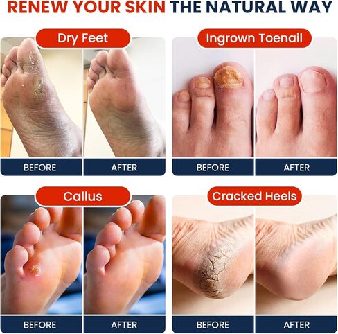 نقع القدم بزيت شجرة الشاي مع ملح إبسوم - لإصلاح أظافر القدم، والقدم الرياضية، وتنعيم مسامير القدم، وتلطيف القدم المتقرحة والمتعبة، وتغير لون الأظافر، ورائحة رائحة القدم، والعناية بالقدمين في السبا - صنع في الولايات المتحدة الأمريكية، 16 أونصة in Kuwait