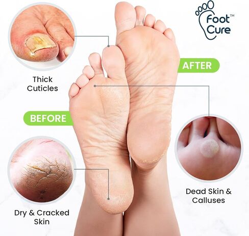 Callus Remover for Feet with Extra Strength Gel & Foot Pumice Stone Set - Easy Way to Remove Hard Calluses & Dead Skin Build-Up - Professional at-Home Foot Care for Men & Women - Made in The USA in Saudi Arabia
