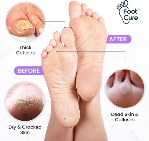 Callus Remover for Feet with Extra Strength Gel & Foot Pumice Stone Set - Easy Way to Remove Hard Calluses & Dead Skin Build-Up - Professional at-Home Foot Care for Men & Women - Made in The USA in Kuwait