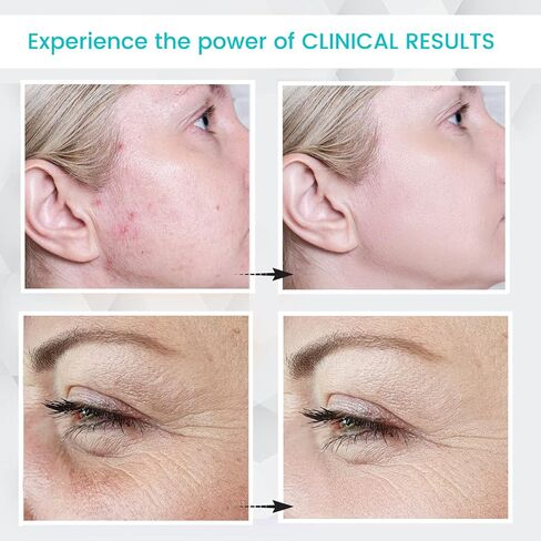 Dermati High Frequency Facial Machine- Portable Handheld High Frequency Facial Wand/Neon in Saudi Arabia