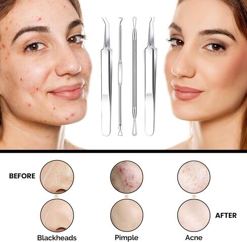 Dermated [16 Pack] Blackhead Remover Tools Pimple Popper Tool Kit | Stainless Steel Professional Pimple Extractor Tool Kit for Blackheads, Blemish, Comdone, Acne, Zit, and Whiteheads for Face & Nose in Saudi Arabia