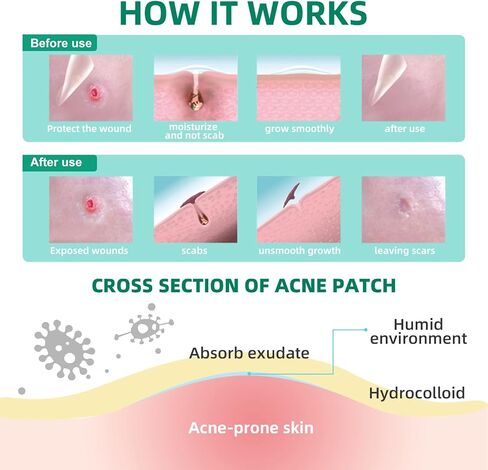 رقع بثور 2021 من اكوتي 210 قطعة مع زيت شجرة الشاي وحمض الساليسيليك والنياسيناميد، بقع عيوب، شفاء سريع، رقع غروانية مائية غير مرئية، اربعة مقاسات 8 ملم، 10 ملم، 12 ملم، 14 ملم in Kuwait