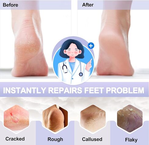 MIG4U Moisturizing Heel Socks Gel for Cracked Feet Treatment, 2 Pairs Toeless Moisturising Sock Organic Cotton for Men Women Heels Hydrating, Foot SPA, Eczema Heal, Pink+Purple in Kuwait