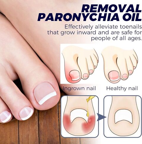 3 قطع من زيت الداحس لازالة اظافر القدمين، زيت الماني للعناية باظافر القدمين، سائل تجديد الاظافر التالف وتغير اللون، زيت علاج اظافر القدم لاصلاح وتحسين صحة اظافر القدم in Kuwait