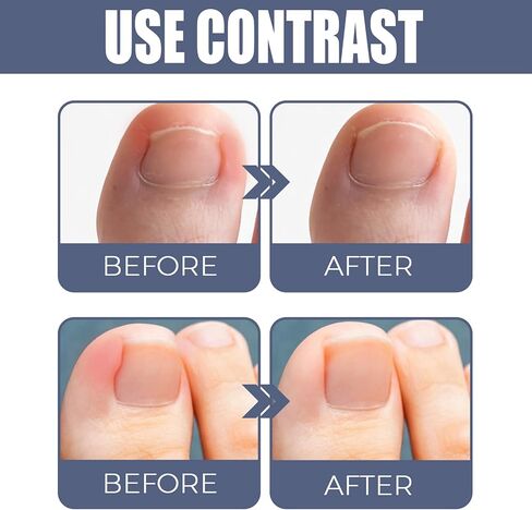 3 قطع من زيت الداحس لازالة اظافر القدمين، زيت الماني للعناية باظافر القدمين، سائل تجديد الاظافر التالف وتغير اللون، زيت علاج اظافر القدم لاصلاح وتحسين صحة اظافر القدم in Kuwait