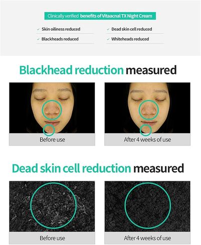 Dr. Different VITAACNAL TX Night Cream for Face - Soothing & Nourishing Retinal Sebum Control Night Cream For Acne-Prone Skin - Blackheads Care Oil-Free Treatment Removes Dead Skin Cells 0.7oz. in Saudi Arabia