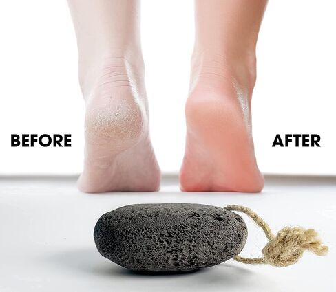 Foot Pumice Stone by VNI Stone - Natural Earth Lava Pumice Stone for Feet callus removal- Callus Warts Corn Removal - Pedicure Exfoliator for Dry Dead Skin, Heels, Palm - Healthy Foot Care Scrubber in Saudi Arabia