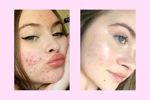 ROSEN Earth Cleanser | Face Wash for Acne and Breakouts | Zinc Oxide and Niacinamide Cleanser in Kuwait