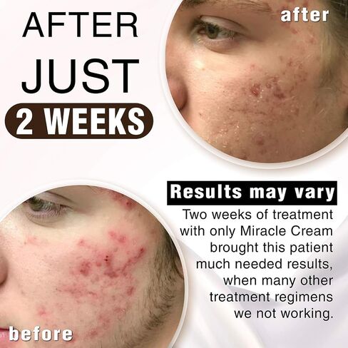 Anna Guanche MD Miracle Cream - Acne Treatment that Quickly Reduces Pimples & Redness in Saudi Arabia
