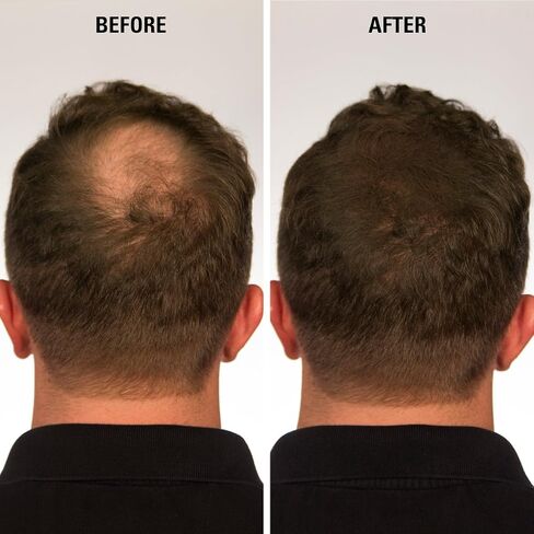Infinity Hair Fiber - Hair Loss Concealer - Hair Thickening Fiber for Men & Women - Dark Brown, 15g in Saudi Arabia