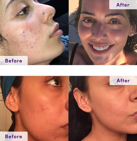 NxN Acne Treatment Kit 4-Step Clear Skin System with Salicylic Acid, Probiotics, Sulfer & Natural Retinols, Control Blemishes & Breakouts, Face Care Solution Set for All Skin Types Including Sensitive in Saudi Arabia