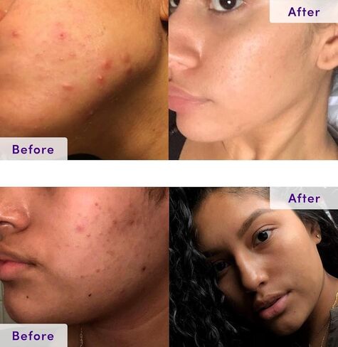 NxN Acne Treatment Kit 4-Step Clear Skin System with Salicylic Acid, Probiotics, Sulfer & Natural Retinols, Control Blemishes & Breakouts, Face Care Solution Set for All Skin Types Including Sensitive in Saudi Arabia