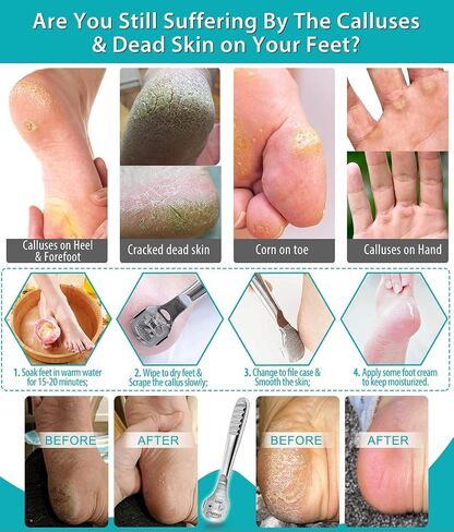Callus Shaver, Callus Remover for Feet, Heel Hard Skin, Corn Callous Removers Scraper in Saudi Arabia