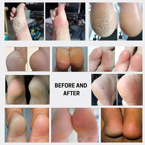 Callus Remover - Instant Exfoliating Peel Foot Spray - Feet Dead Skin Remover Cracked Heels Softener – Home Spa Pedicure Treatment - Works With any Foot File or Scrubber. Wonder Pedi in Kuwait
