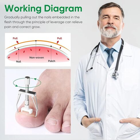 Ingrown Toenail Treatment, Professional Ingrown Toenail Removal Kit with File and Lifter, 50Pcs Toenail Corrector Patch and Toe Protectors for Toenail Correction Pain Relief in Kuwait