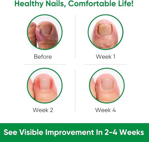 Ingrown Toenail Treatment, Professional Ingrown Toenail Removal Kit with File and Lifter, 50Pcs Toenail Corrector Patch and Toe Protectors for Toenail Correction Pain Relief in Kuwait