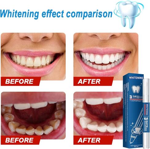 قلم تبييض الأسنان، عبوتين من جل علاجات تبييض الأسنان، فعال وغير مؤلم، لا يسبب حساسية، مناسب للسفر، سهل الاستخدام، ابتسامة بيضاء جميلة، نكهة النعناع الطبيعية in Kuwait